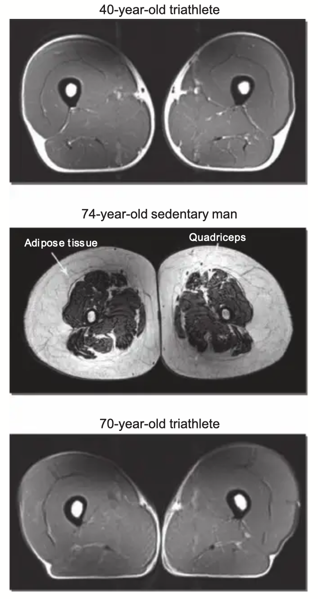 MRI cross-sections of the quadriceps: 40-year-old triathlete vs 74-year-old sedentary vs 74-year-old triathlete.